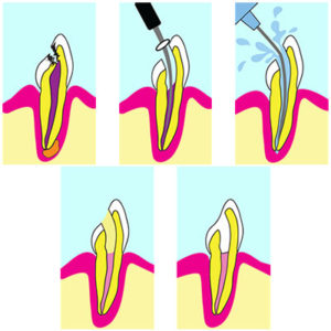 Lonsdale Place Dental - Root Canal Treatment