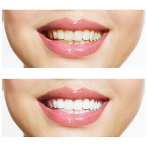 Lonsdale Place Dental - Teeth Whitening